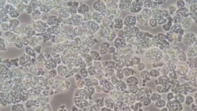 Family's plea: Be aware of amoeba dangers