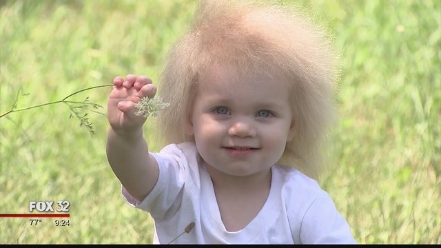 Chicago mom shares story of daughter's 'Uncombable Hair Syndrome'