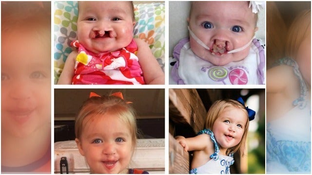 Preschooler Born with Cleft Lip, Palate ‘Thriving' after Surgeries