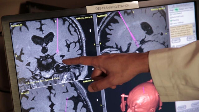 Embedded electrode brings relief to Parkinson's patient