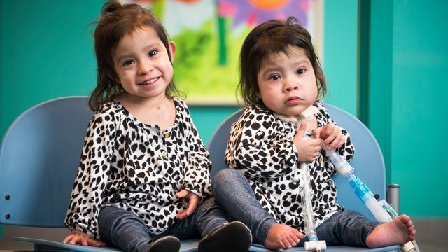 Formerly conjoined twins 'thriving' one year after historic surgery
