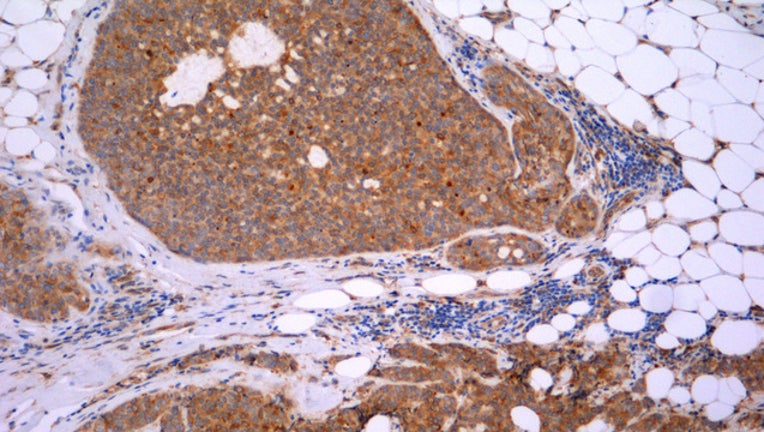 bea5cfc9-BREAST CANCER CELLS_1476481683581.jpg