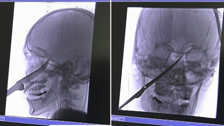 knife in boy's skull_1560946269926.jpg.jpg