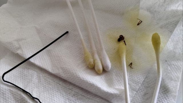 Man finds spider in his ear after feeling 'tickling,' hearing 'scratching'