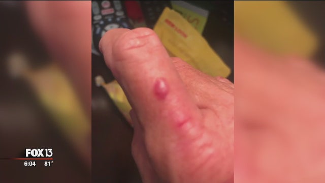 Pelican rescue turns into flesh-eating vibrio infection for Manatee County woman