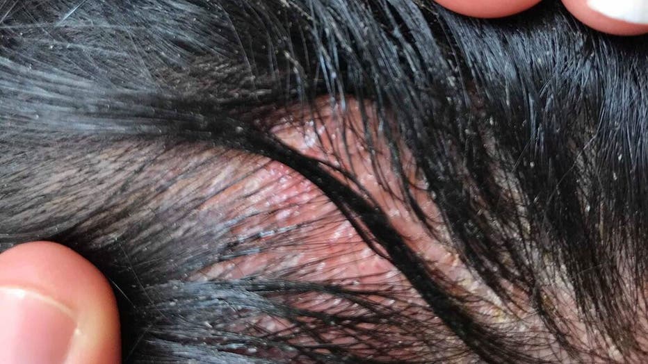 Woman S Allergic Reaction To Hair Dye Causes Severe Swelling In Face Head   Julie Yacoub 3 MDW Features 