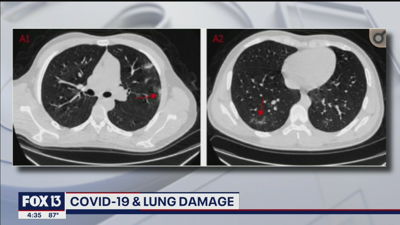 Lung Damage In Covid-19 Patients