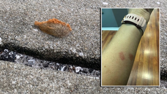 Puss caterpillar leaves its mark on Odessa woman after outdoor workout