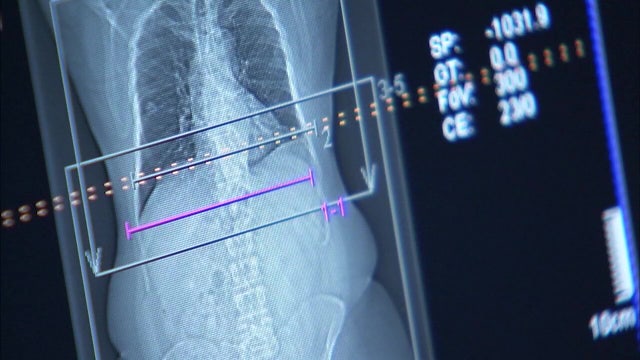 Doctors join Al Roker in urging men to get tested for prostate cancer