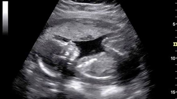 Florida lawmakers introduce legislation to ban abortions after 15 weeks