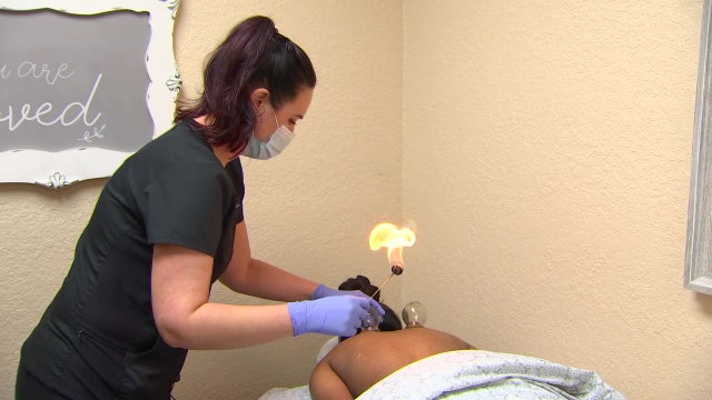 St. Petersburg clinic touts ancient form of cupping to heal muscles, reduce inflammation