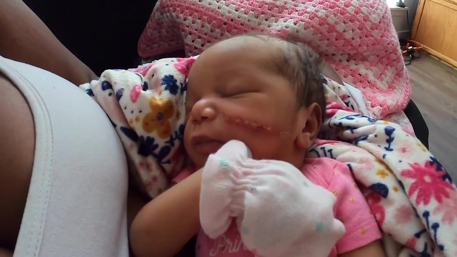 Newborn baby's face gets cut during emergency C-section