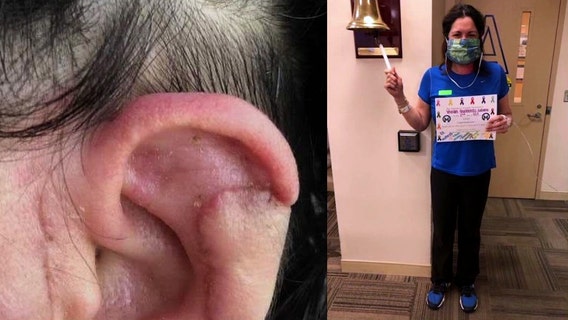 Experimental skin cancer vaccine developed in Tampa saves woman's life