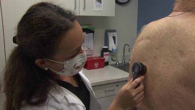 Moffitt expert explains the ABCDE melanoma check