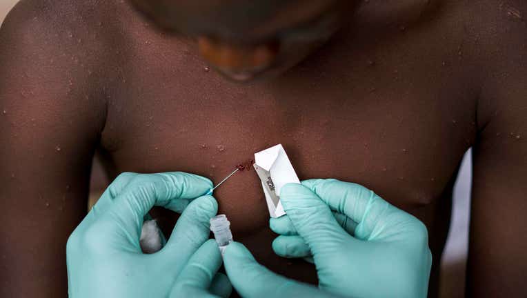 CDC (Center of Disease Control) Team in Republic of Congo Study MonkeyPox Virus