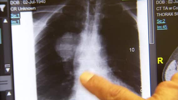 Tampa doctor studying what's behind lung cancer in non-smokers