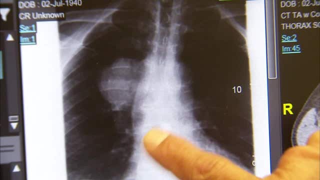 Tampa doctor studying what's behind lung cancer in non-smokers