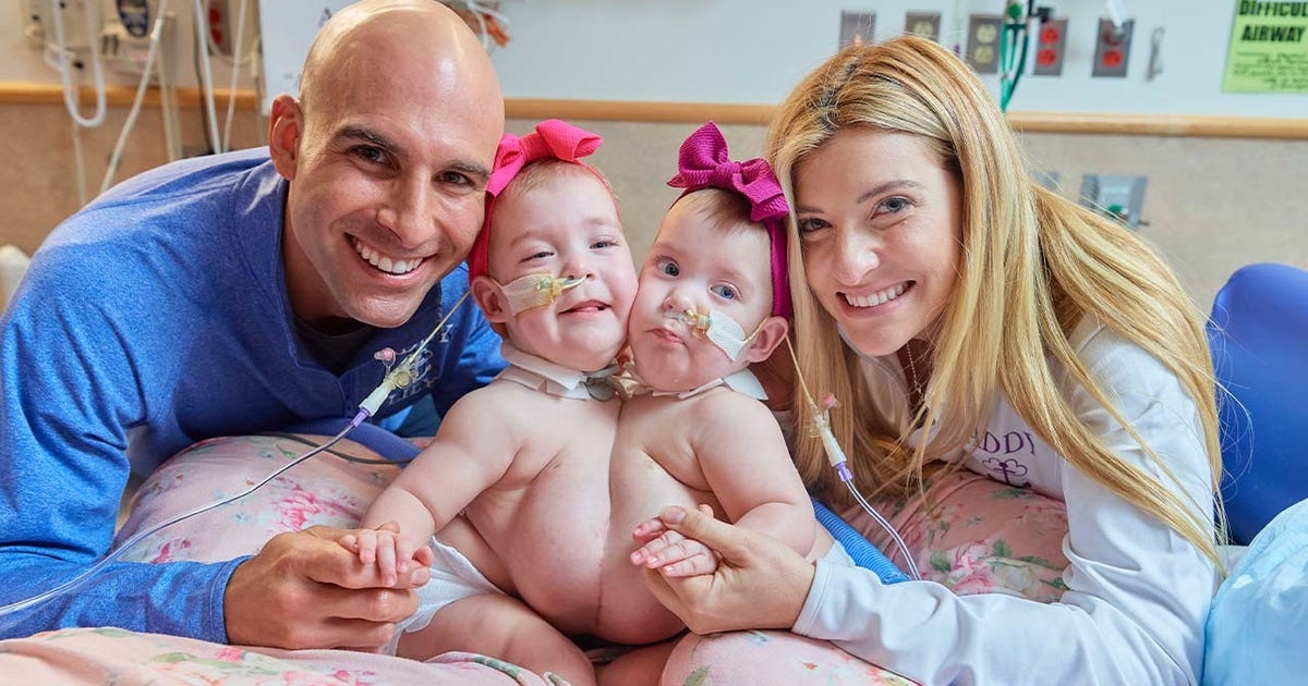 Conjoined twin girls, joined at chest, successfully separated by