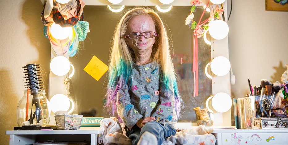 Adalia Rose YouTuber with rare genetic condition dies at 15