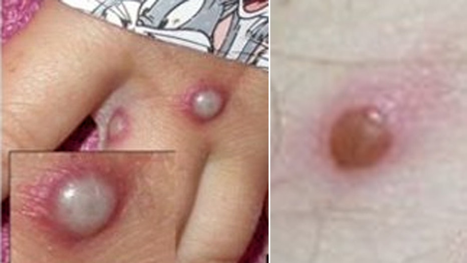 Monkeypox lesions (Photos courtesy: CDC)