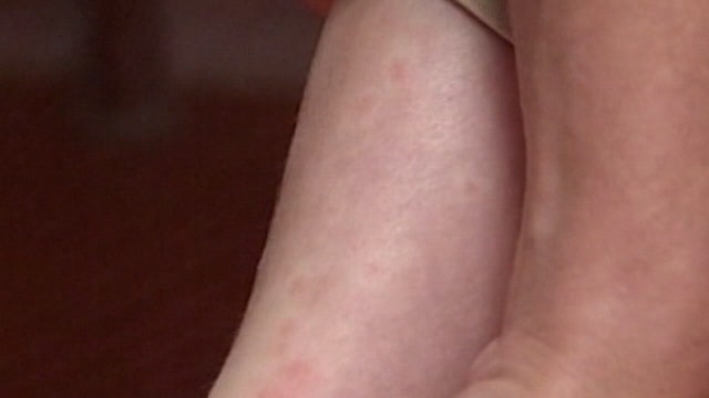 Tampa doctors explain Ramsay Hunt syndrome following Justin Bieber diagnosis