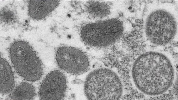 Florida among states with most monkeypox cases, health officials say