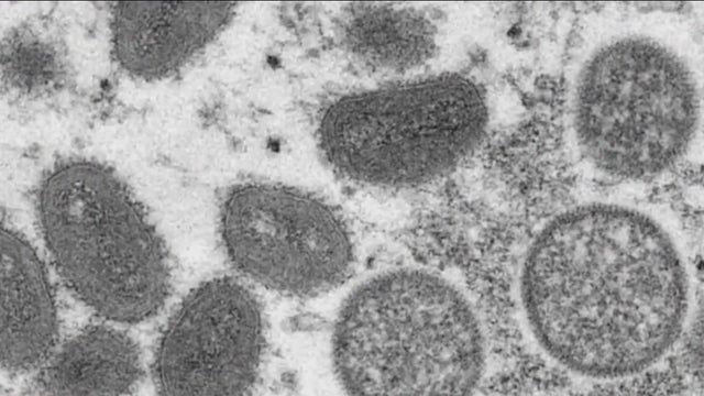 Florida among states with most monkeypox cases, health officials say