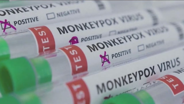 Florida reports first pediatric monkeypox case in Martin County