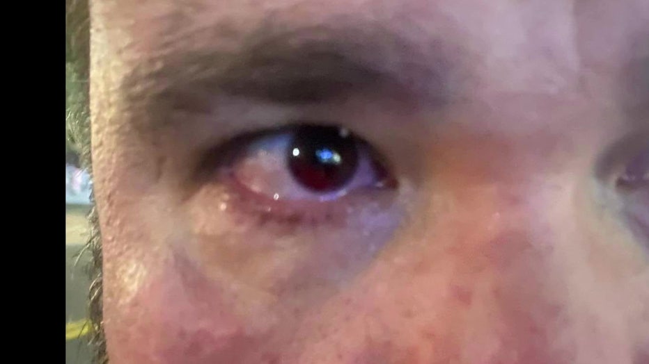 Mike Schuman eye after being hit by a gel pellet in St. Petersburg.