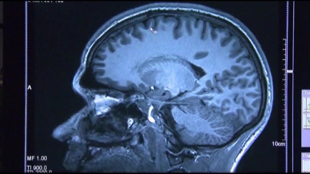 New Alzheimer's therapy appears to slow cognitive decline, giving hope to many impacted by the disease