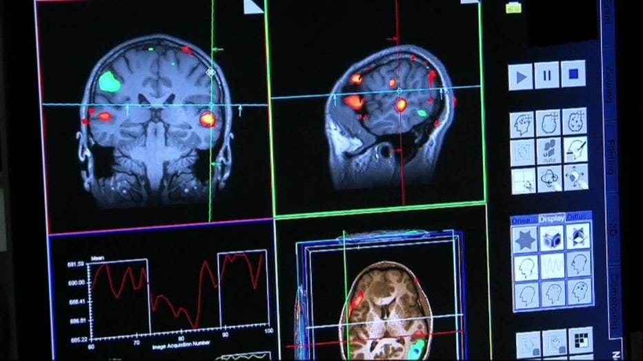 Huntington's disease is a fatal genetic disease that affects nerve cells in the brain.