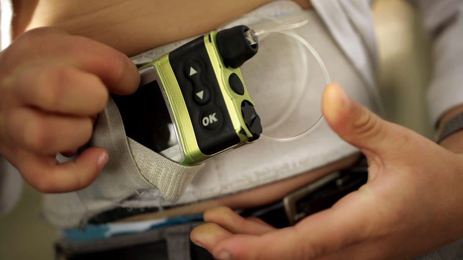 Six-year-old son Merrick Horne, who is diabetic shows his insulin pump which is attached around his waist, in Corte Madera, Ca, Saturday May 28, 2011. He and his mother Suzanne Kline, are part of a court case about who can give insulin to diabetic childr