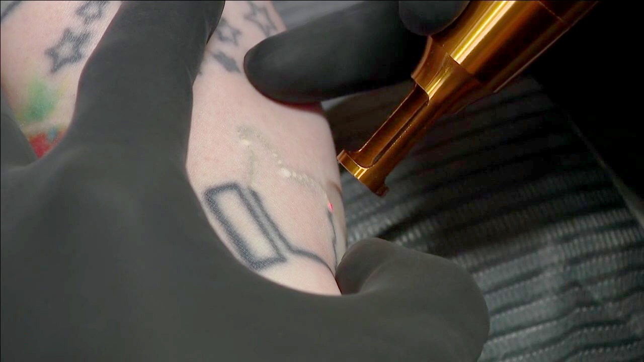 Limited Tattoo Excision  Tattoo Removal Surgery Gainesville Florida