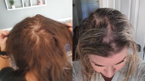 Olaplex lawsuit: Over 30 women claim they suffered hair loss, scalp damage