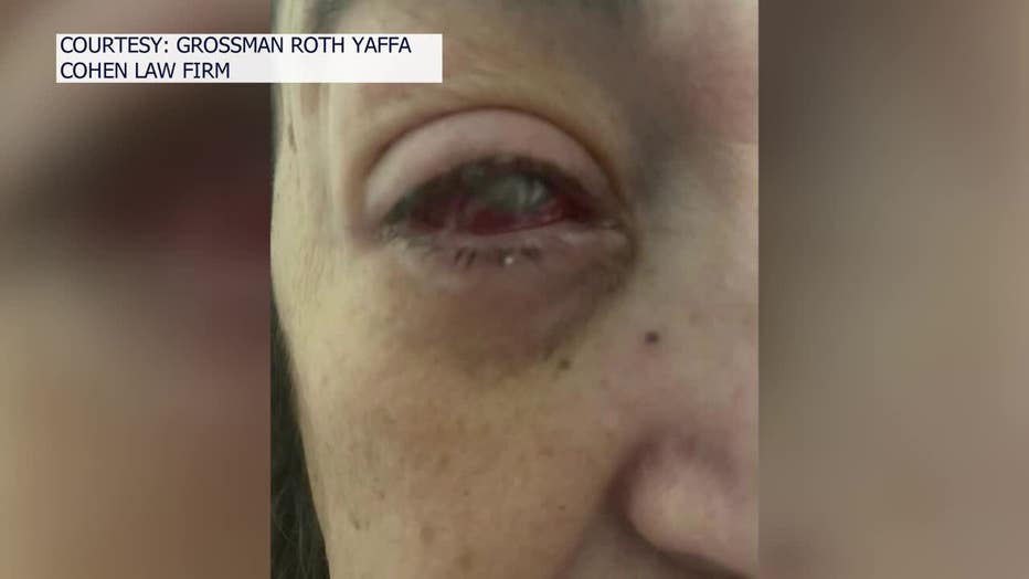 Eye drops nightmare South Florida woman loses eye after using