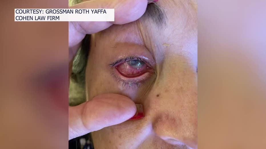 Eye drops nightmare South Florida woman loses eye after using