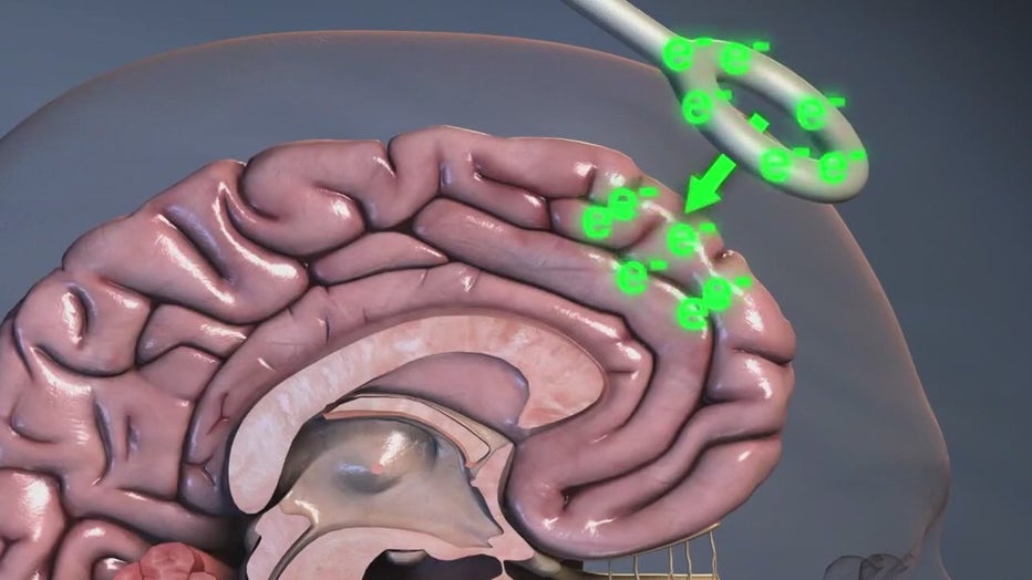 TMS is being used to treat depression.