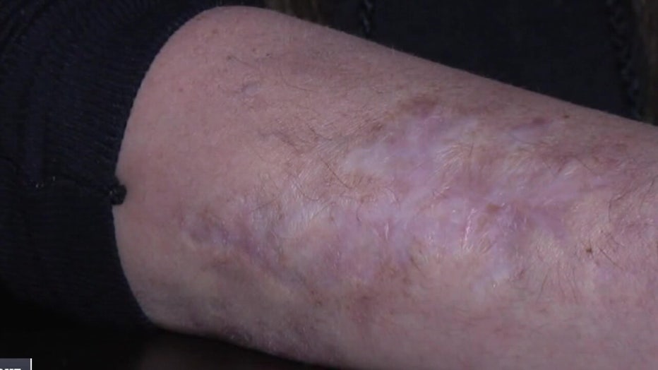 Drug use could lead to peeling skin or amputation.
