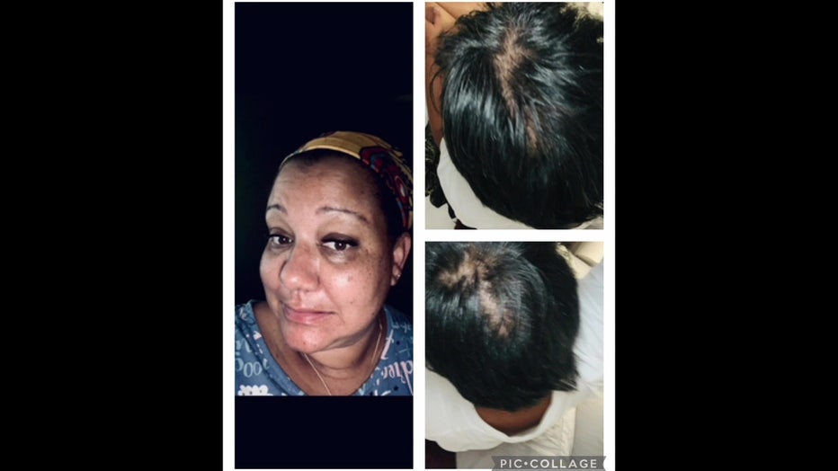 Monica Smith suffered hair loss while undergoing chemotherapy.