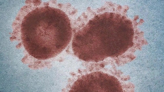 Shortness of breath and palpitations possible symptoms after COVID-19, cardiologist says