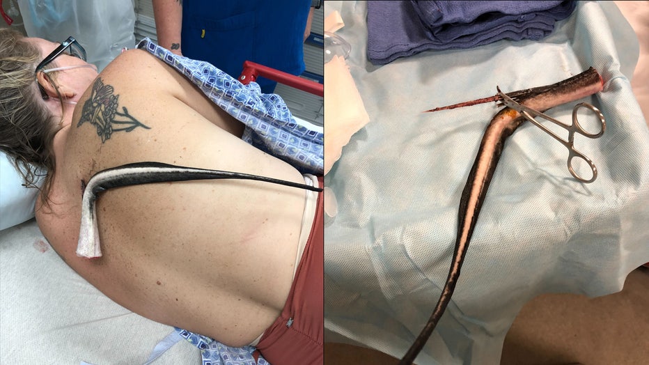 Side by side images of Kristie O'Brien's back with the stingray barb and the barb after it was removed. Image is courtesy of Kristie O'Brien. 