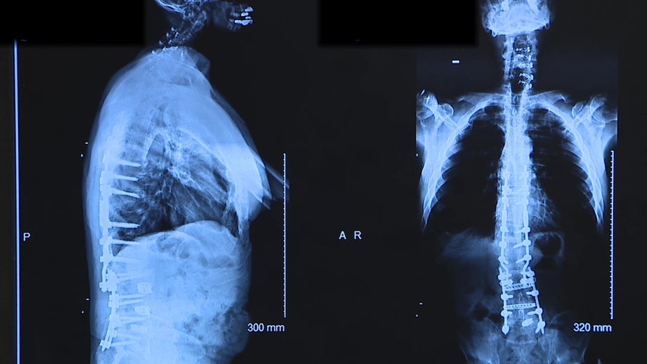Several spinal surgeries left Blair's spine fused flat (left), but the TGH surgery helped restore his back's natural curvature. 