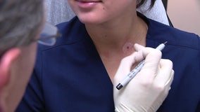 Smart sticker provides non-invasive check for skin cancer