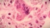 Florida's 9th case of measles confirmed in Polk County: Health officials