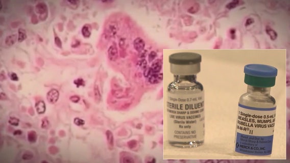 Measles outbreak leads CDC to update travel guidelines
