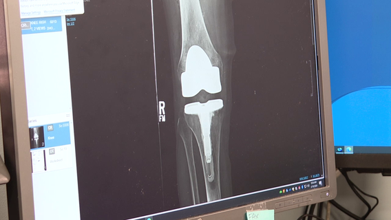 'Smart Knee' could change future of knee replacements