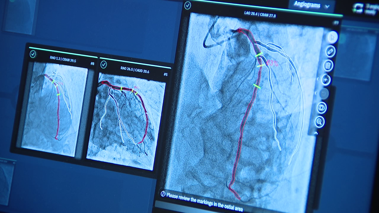 Bay Area hospital using AI technology for new cardiac procedure