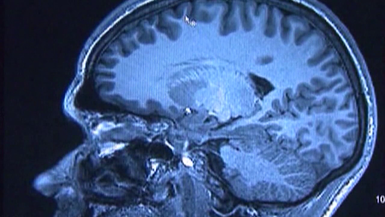 Alzheimer's treatment shows promise, health experts say