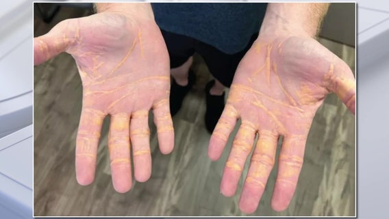 Man eating 6-9 pounds of butter and cheese a day develops ‘cholesterol hands’ while on carnivore diet: JAMA