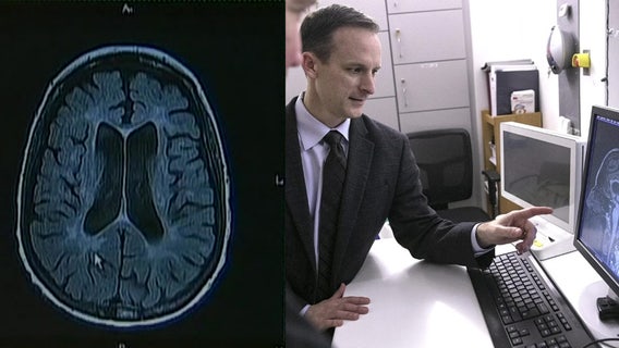 UF researchers using artificial intelligence to detect Parkinson's disease more accurately